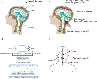 Possible mechanism and Atorvastatin-based treatment in cupping therapy-related subdural hematoma: A case report and literature review